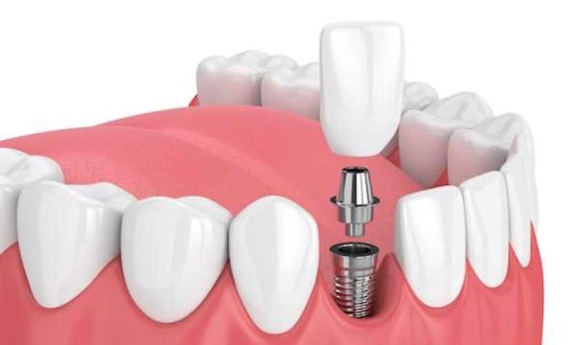 3D illustration of a dental implant with crown and abutment replacing a missing tooth in Red Lion.