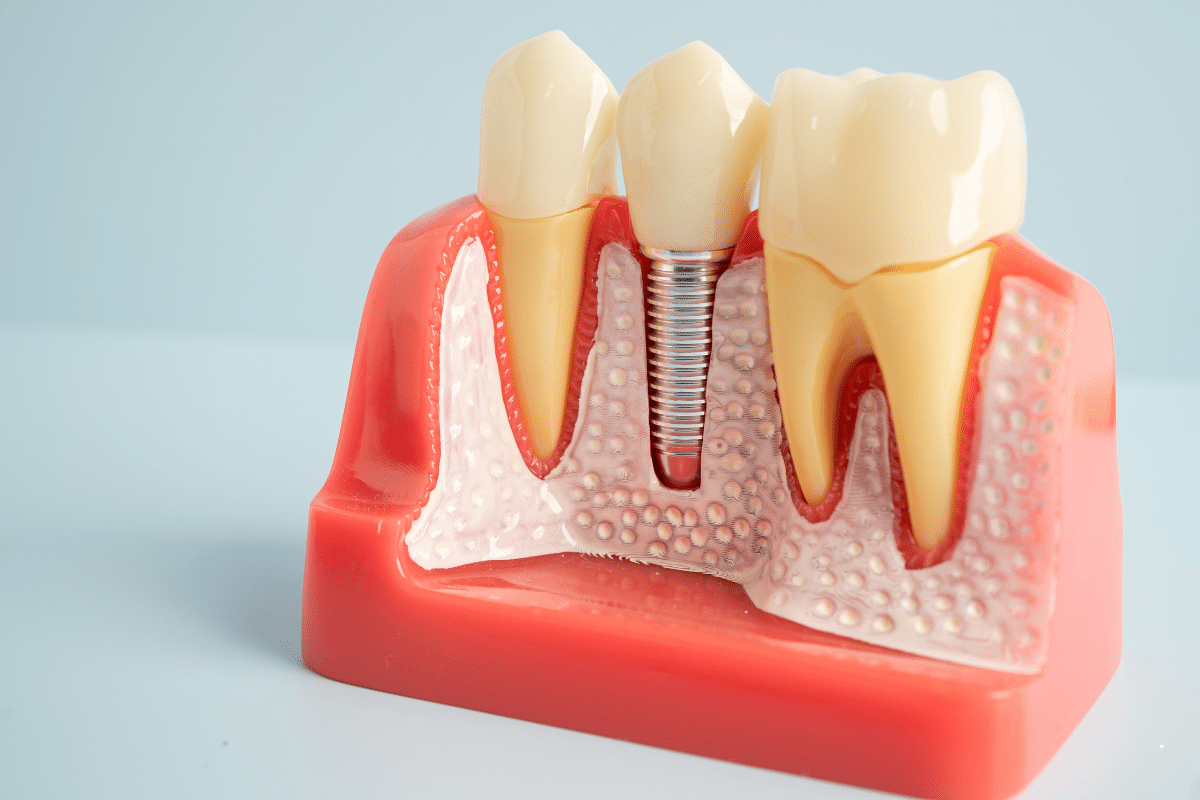 Dental Implants in York and Red Lion PA