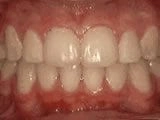Crowding of Teeth After