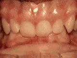 Deep Overbite Before