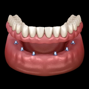 Full Arch Replacement