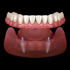 Improved Denture Stability