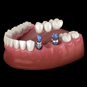 Multiple Teeth Replacement