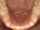 Non-Braces Treatment Options After
