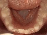 Non-Braces Treatment Options Before