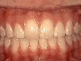 Overjet After