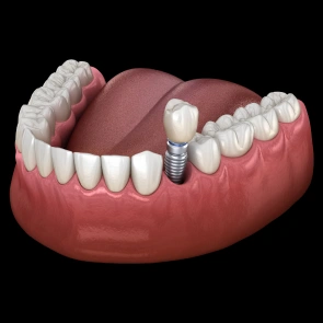 Single Tooth Replacement