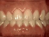 Teeth Spacing After