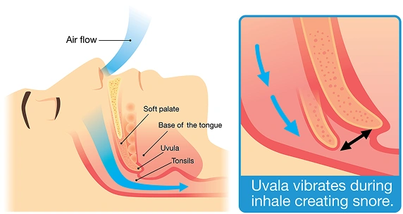 Typical Signs of Sleep Apnea Encompass