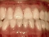 Underbite After
