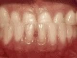 Underbite Before