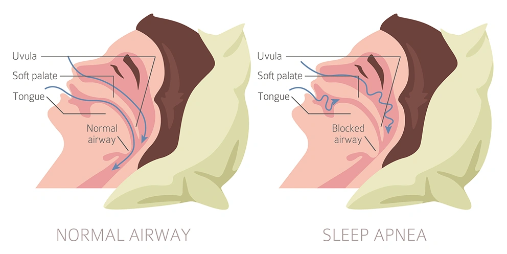 What is Sleep Apnea